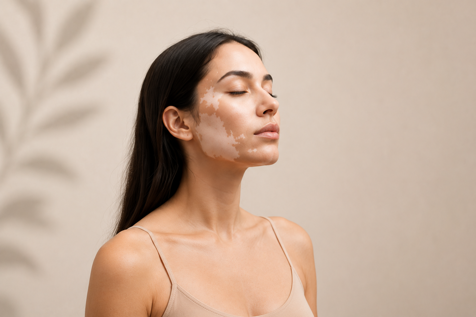 Acrofacial vitiligo